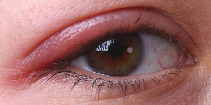 Miért szemviszketés: szemhéjgyulladás