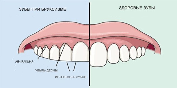 Fogcsikorgatás: Egészséges fogak és a fogak fogcsikorgatás közben