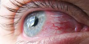 Kötőhártya-gyulladás: miért elvörösödik a szemét, és hogyan kell kezelni őket