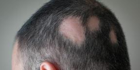Alopecia: miért veszít hajat és hogyan kell kezelni