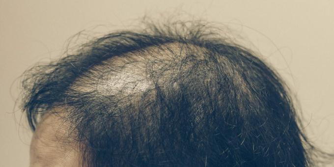 Anagénes alopecia