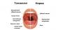 Krónikus mandulagyulladás: tünetek, szövődmények, kezelés és egyebek