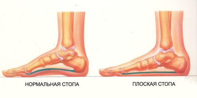 gyakorolja a lúdtalp: normál és lapos talp