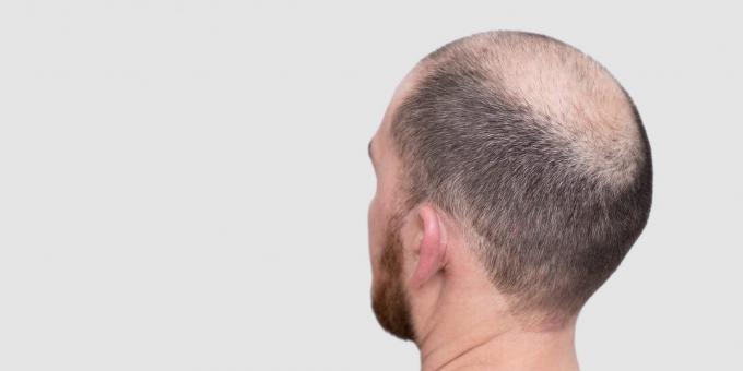 Diffúz telogén alopecia