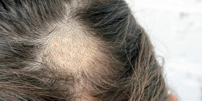 Fertőző alopecia