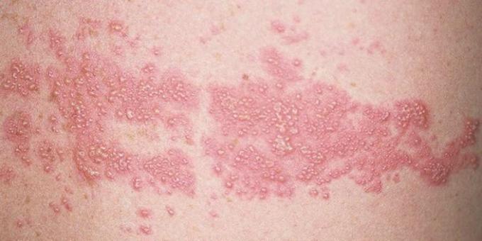 Derékfájás: herpes zoster