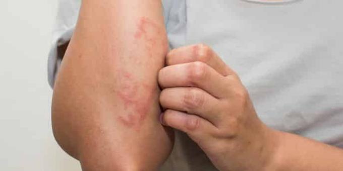 Ellenőrizze az Ön tüneteit az allergia tüneteinek